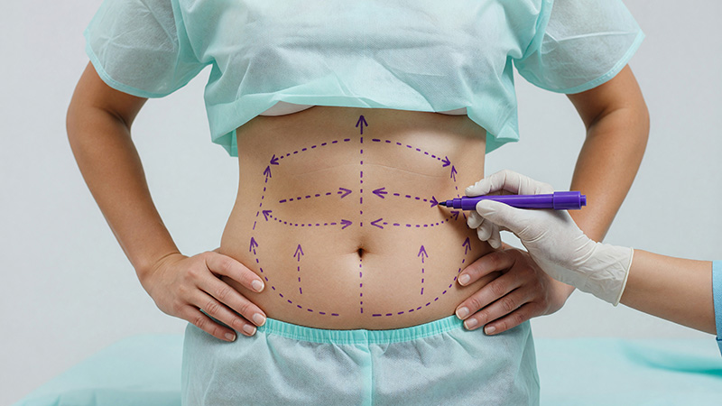 Chirurgie de l'obésité, enquête